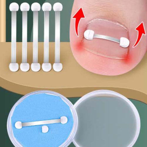 Ingrown Toenail Correction Bands