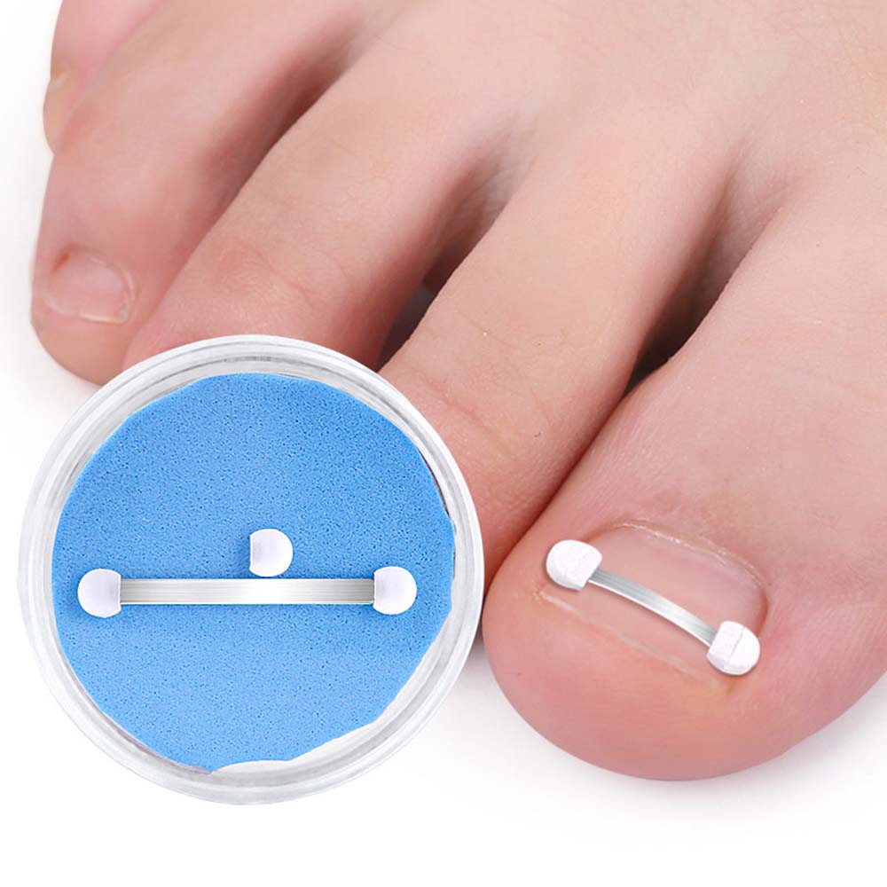 Ingrown Toenail Correction Bands