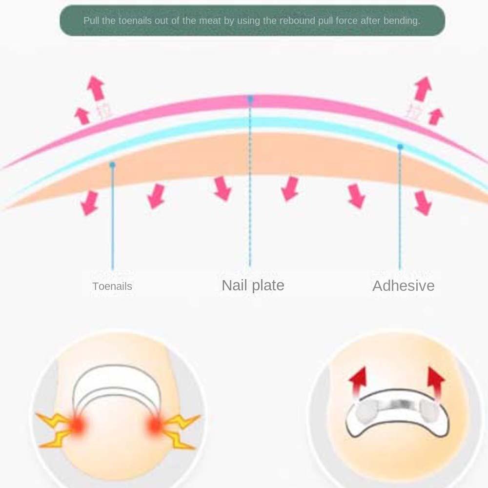 Ingrown Toenail Correction Bands