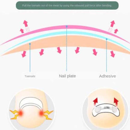 Ingrown Toenail Correction Bands