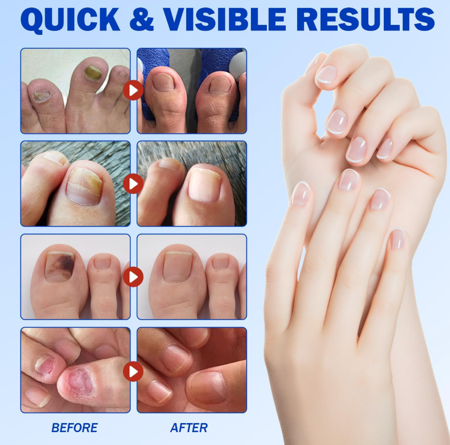Fungal Nail Repair Patches