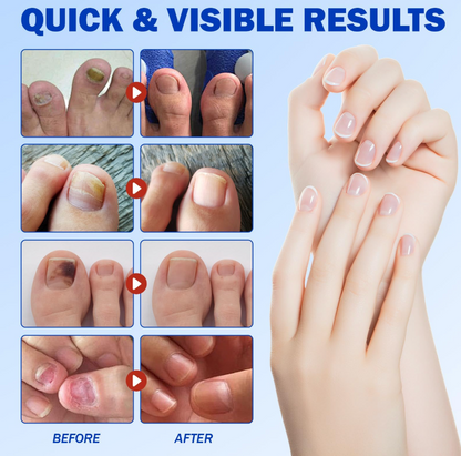 Fungal Nail Repair Patches