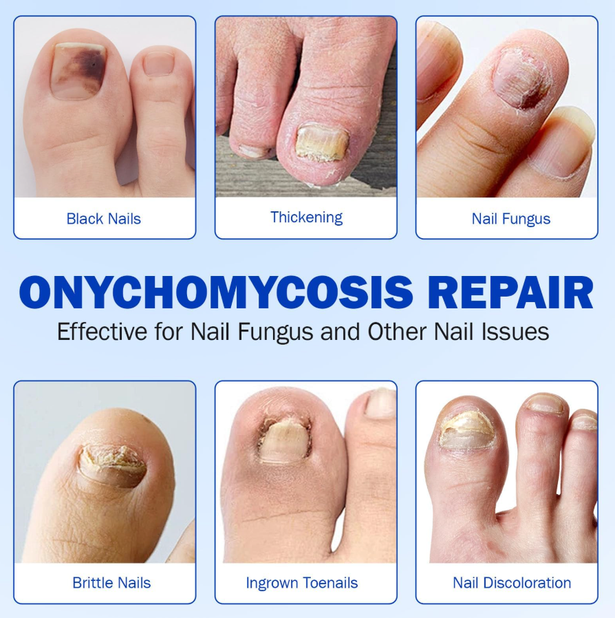 Fungal Nail Repair Patches