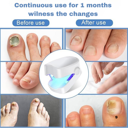 Nail Fungus Cleaning Device With LED Display Pro