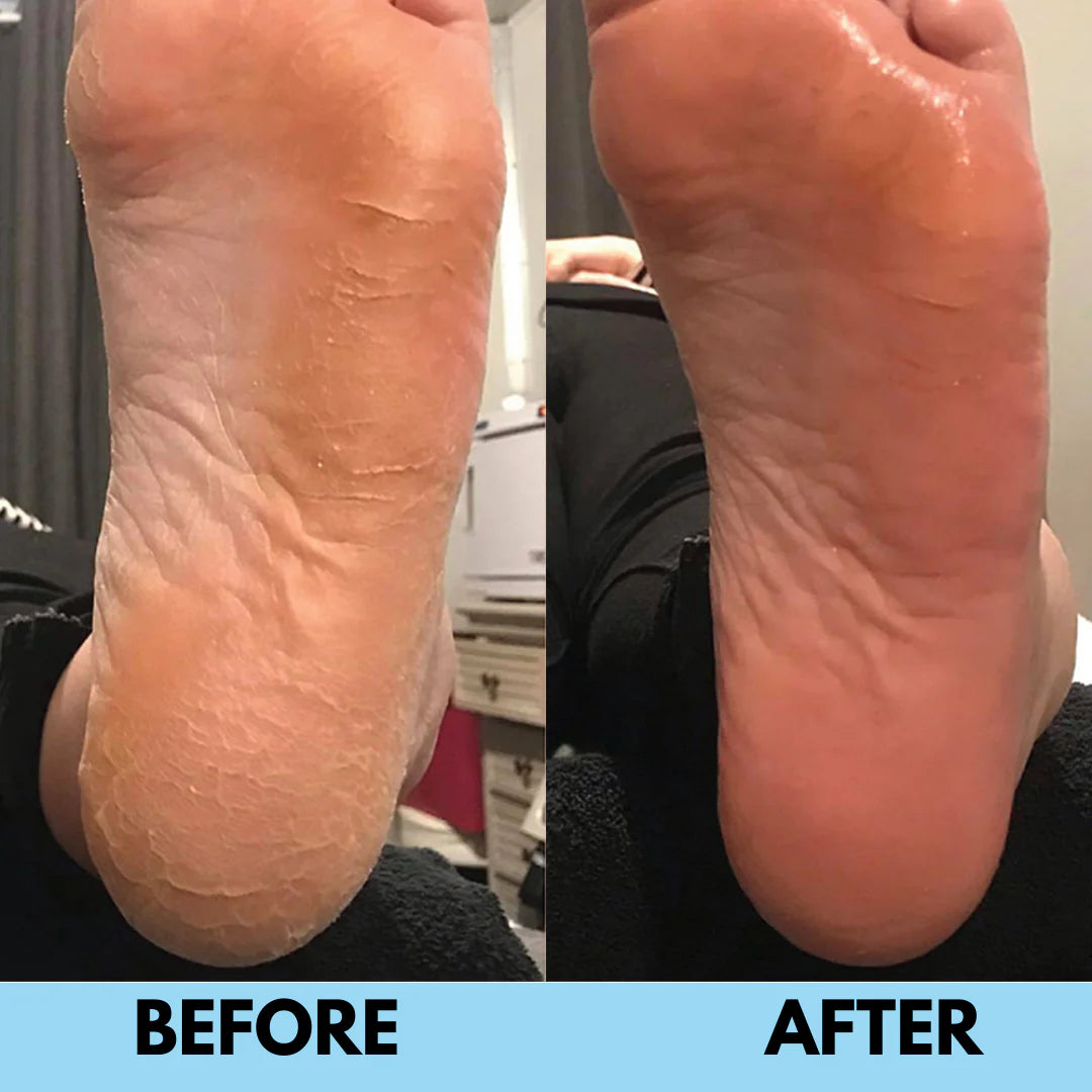 Electric Callus Remover