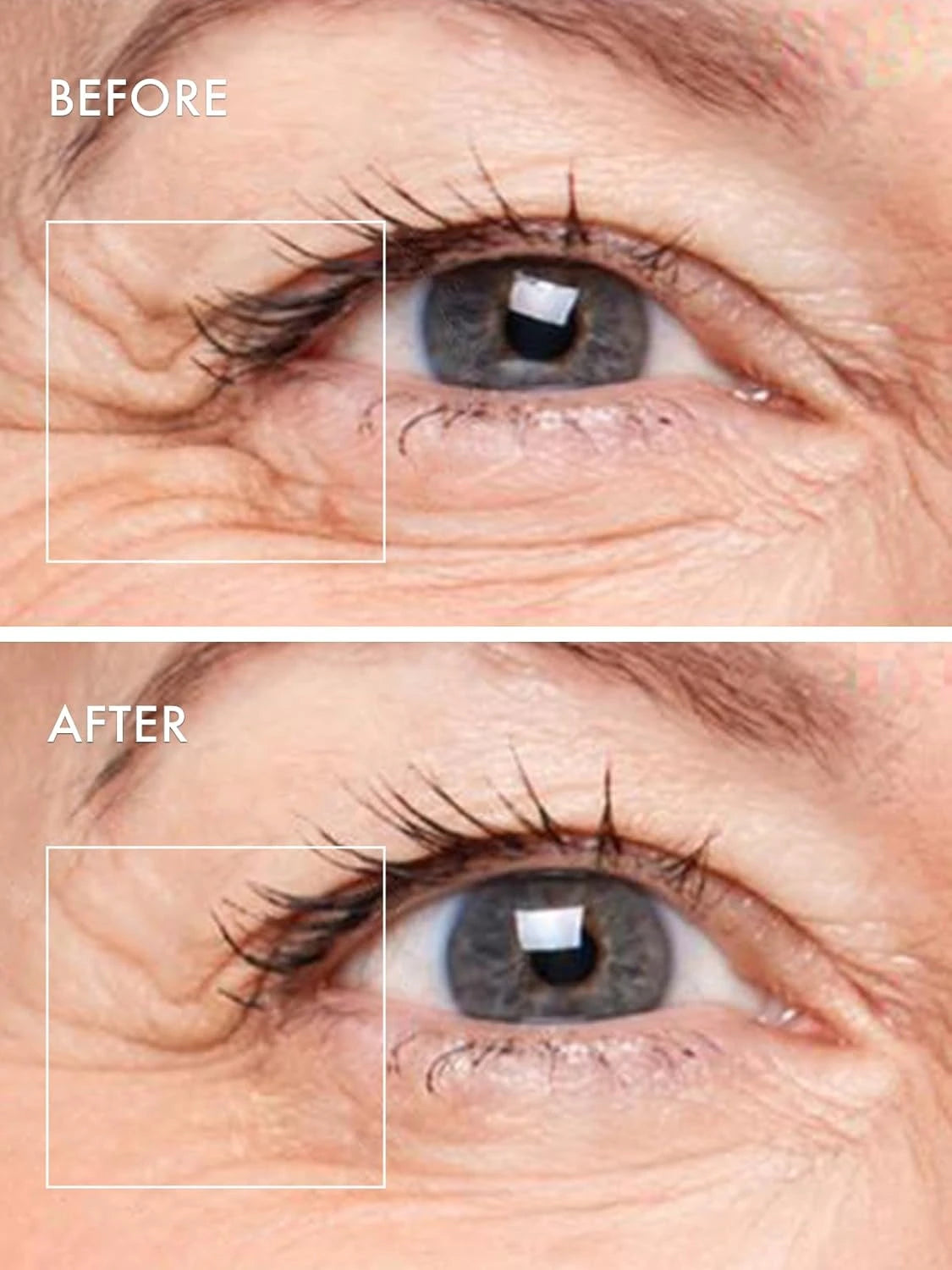 Microneedle Eye Patches