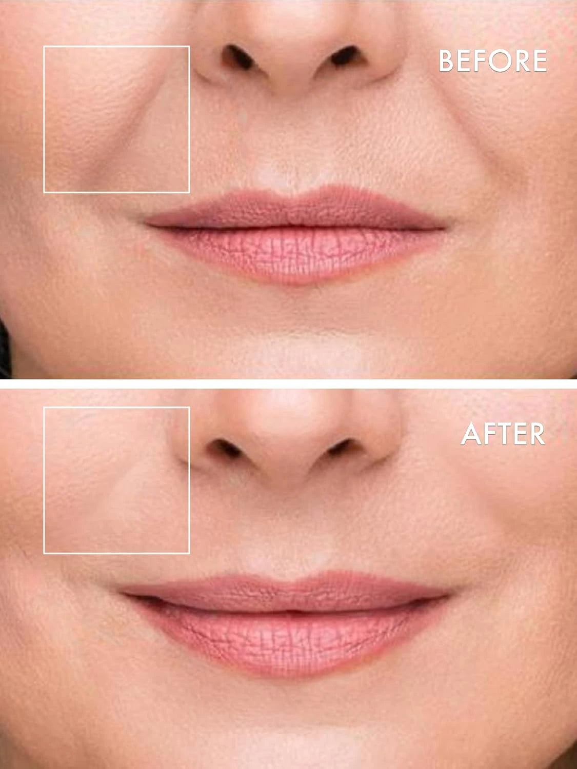 Microneedle Eye Patches