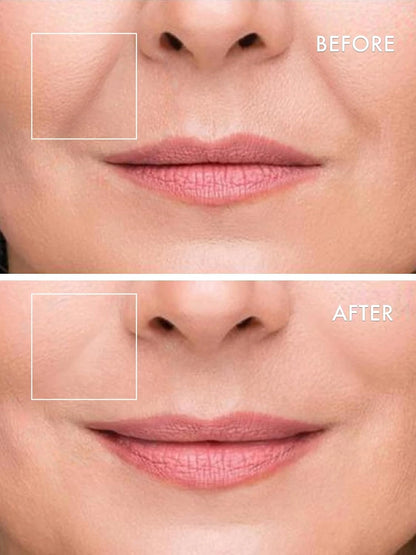 Microneedle Eye Patches