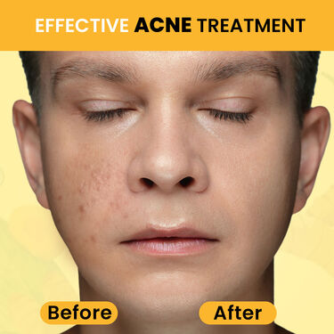 Turmeric Milk Face Serum- Reduce Dark Spot, Dark Circle & Acne