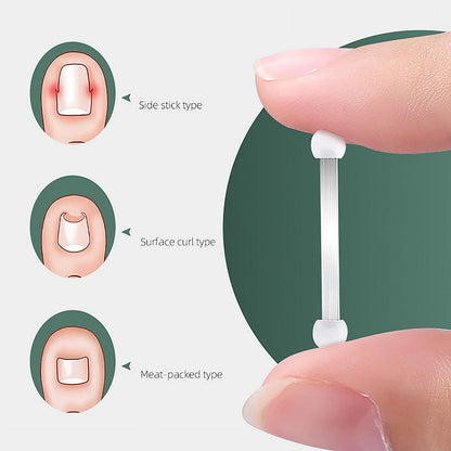 Ingrown Toenail Correction Bands