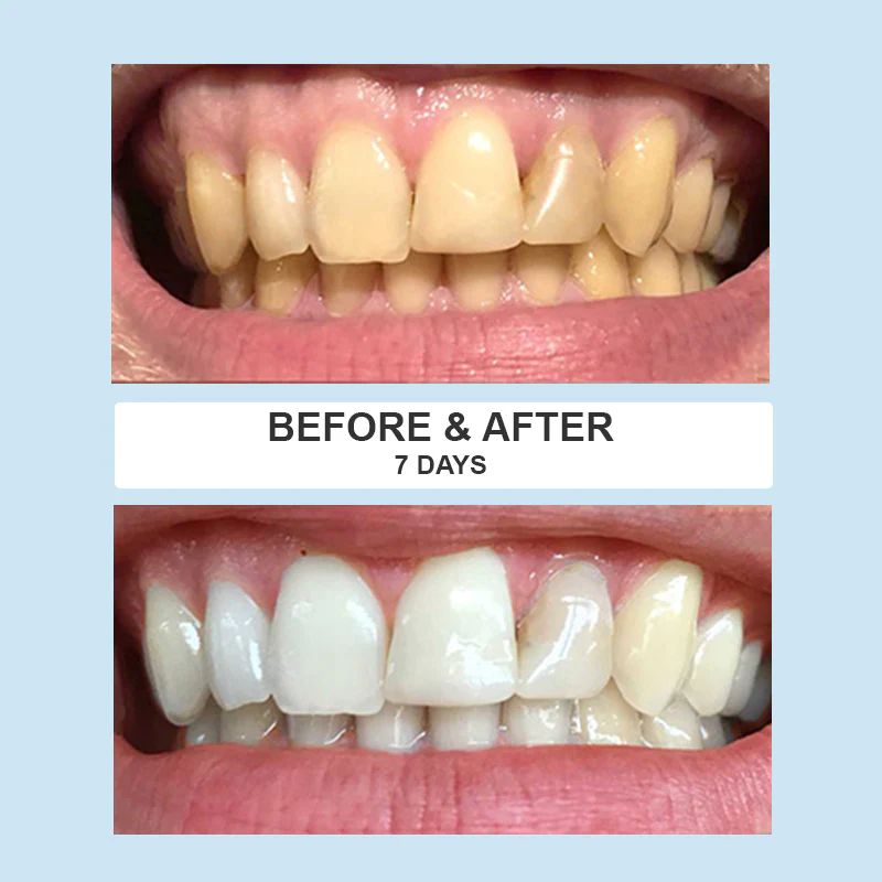 ShineSmile™ - LED Teeth Whitening Kit