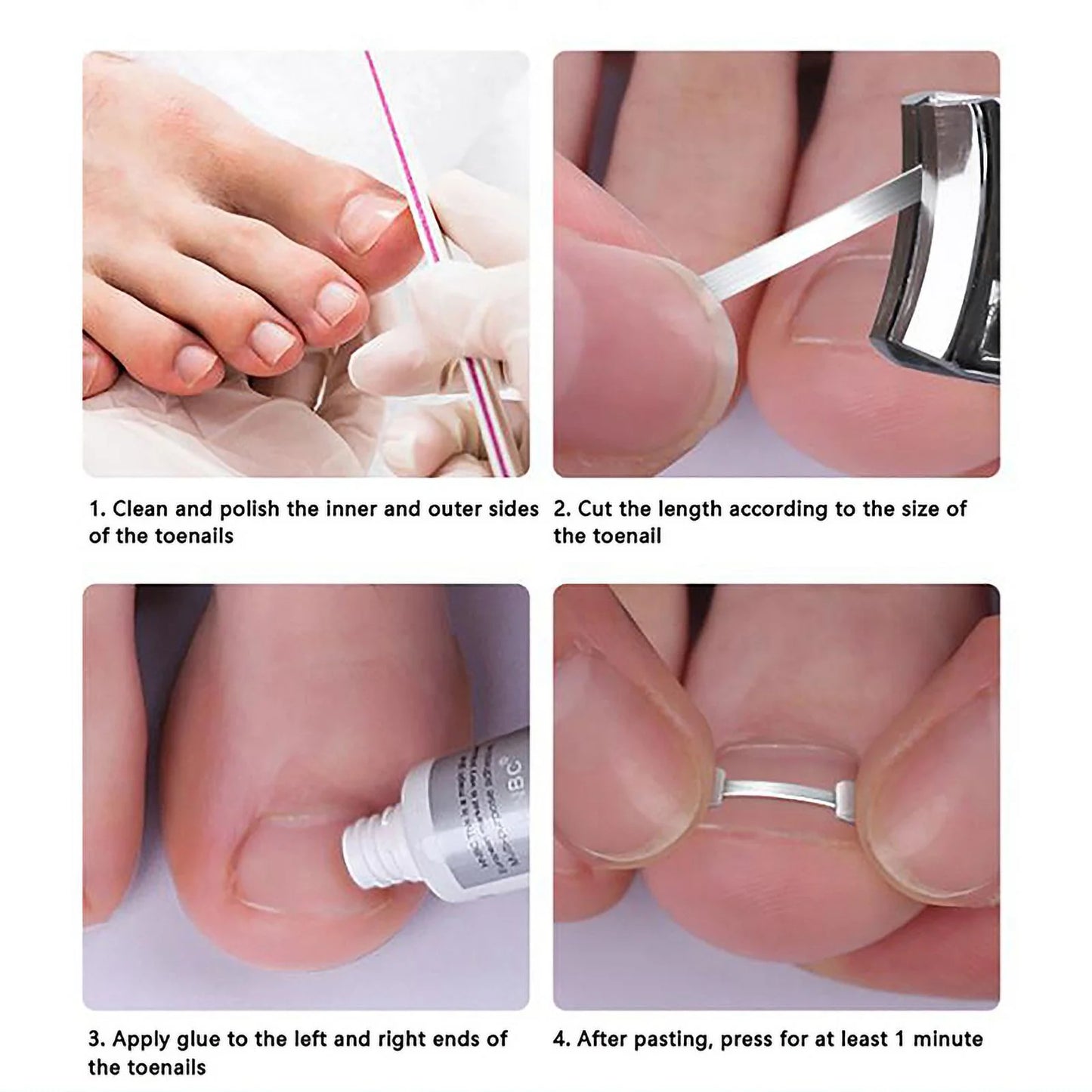Ingrown Toenail Correction Bands